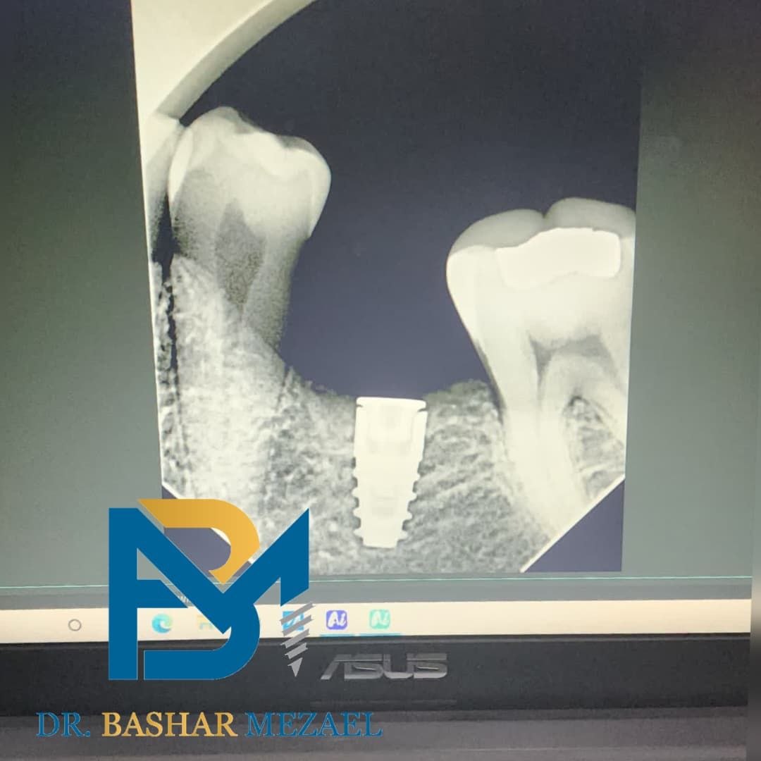 صورة شعاعية لزرعة من حالة سريرية للدكتور بشار مزعل