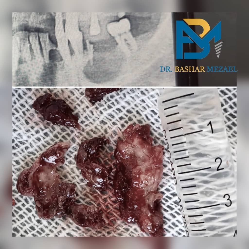 مجموعة صور سريرية وشعاعية لحالة جراحية لدى الدكتور بشار مزعل